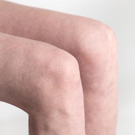 Potential complications with BTB (patellar tendon) grafts for ACL reconstruction