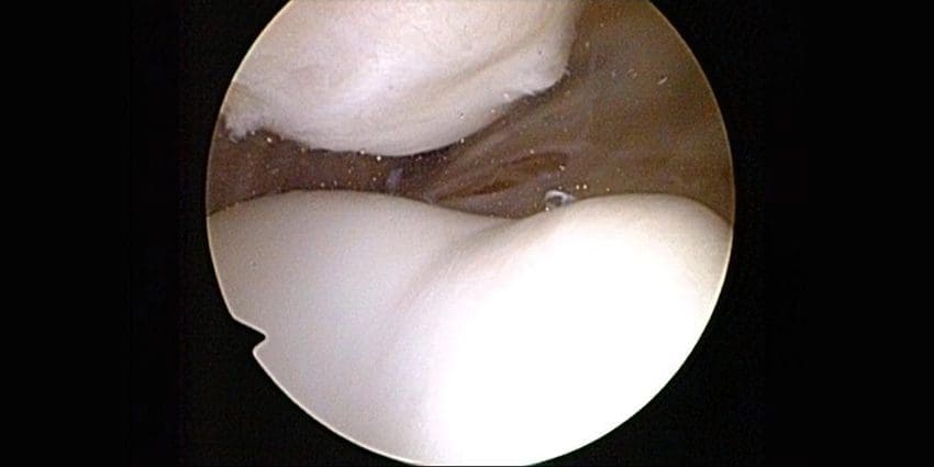 It’s the Patellofemoral Height, Stupid! 1 It’s the Patellofemoral Height, Stupid!