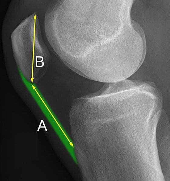 Surgical Treatment of Iatrogenic Patella Baja 3 Surgical Treatment of Iatrogenic Patella Baja