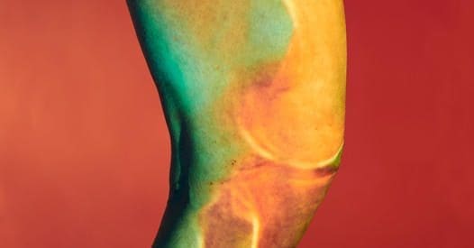 The Bridge-Enhanced ACL Restoration Implant—known as the BEAR implant 8 BEAR Implant