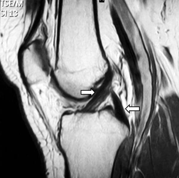 Anterior knee pain following ACL reconstruction