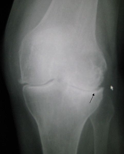Patellofemoral joint loading and early osteoarthritis after ACL reconstruction