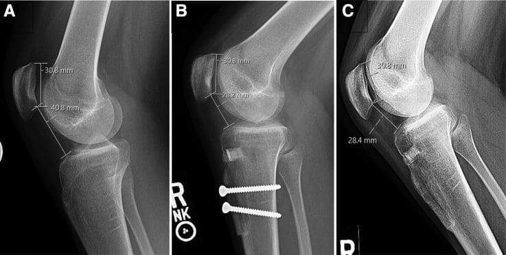 Lateral radiographs of the right knee from a 19-year-old female patient with patella alta and patellar instability who was indicated for tibial tubercle osteotomy with distalization.