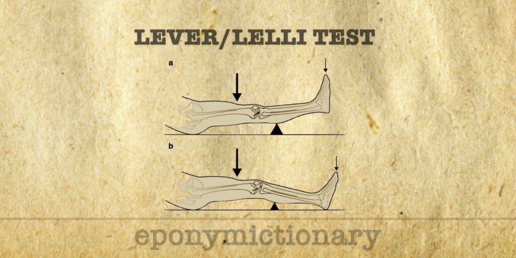 Lever Test or Lelli Test for Acute ACL Tear
