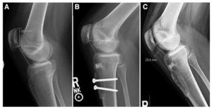 Proximal bone block with distal screw trajectory improves mechanical stability during distalization tibial tubercle osteotomy
