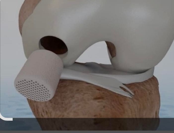 Cartiheal Is Back: New Cartilage Injury Treatment 1 Cartiheal, a new treatment for cartilage injury