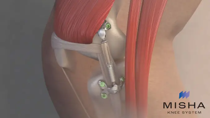 Moximed MISHA™ Knee System Treats First Commercial Patients in United States - Dr. Strickland has used this system to treat patients in New York City and Connecticut